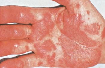 手掌脓溢性皮肤角化病
