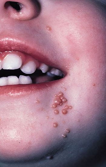 儿童脸上的传染性软疣