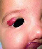 婴儿血管瘤（也称为草莓状或婴儿状血管瘤）
