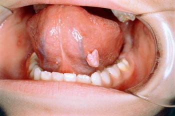 口腔内感染的生殖器疣