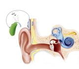 耳蜗植入