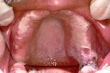 口腔溃疡和炎症