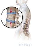 脊柱压缩性骨折