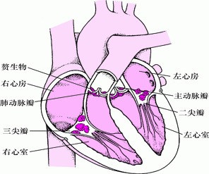 感染性心内膜炎的内部图