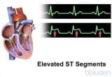 急性冠状动脉综合征（心脏病发作；心肌梗死；不稳定型心绞痛）