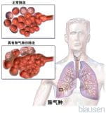 慢性阻塞性肺疾病（COPD）