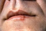 唇部的溃疡、炎症和其他变化