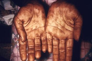 梅毒——二期：手掌皮疹