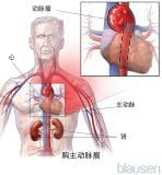 胸主动脉瘤