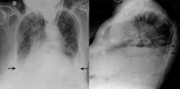 双侧胸腔积液患者的胸部X光检查