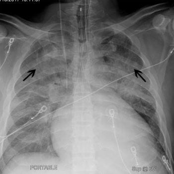 心脏增大和头侧化患者的胸部X线检查