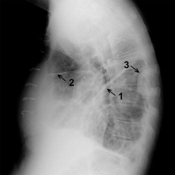 小肺裂和大肺裂积液患者的胸部X光检查