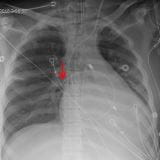 肺动脉导管（PAC）监测