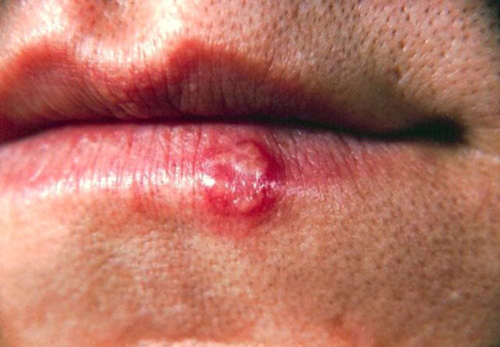 唇疔疮的症状的照片图片