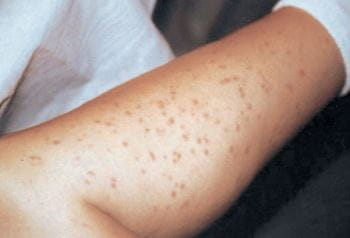 色素性荨麻疹（腿部）