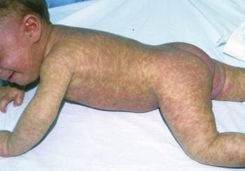 色素性荨麻疹（婴儿）