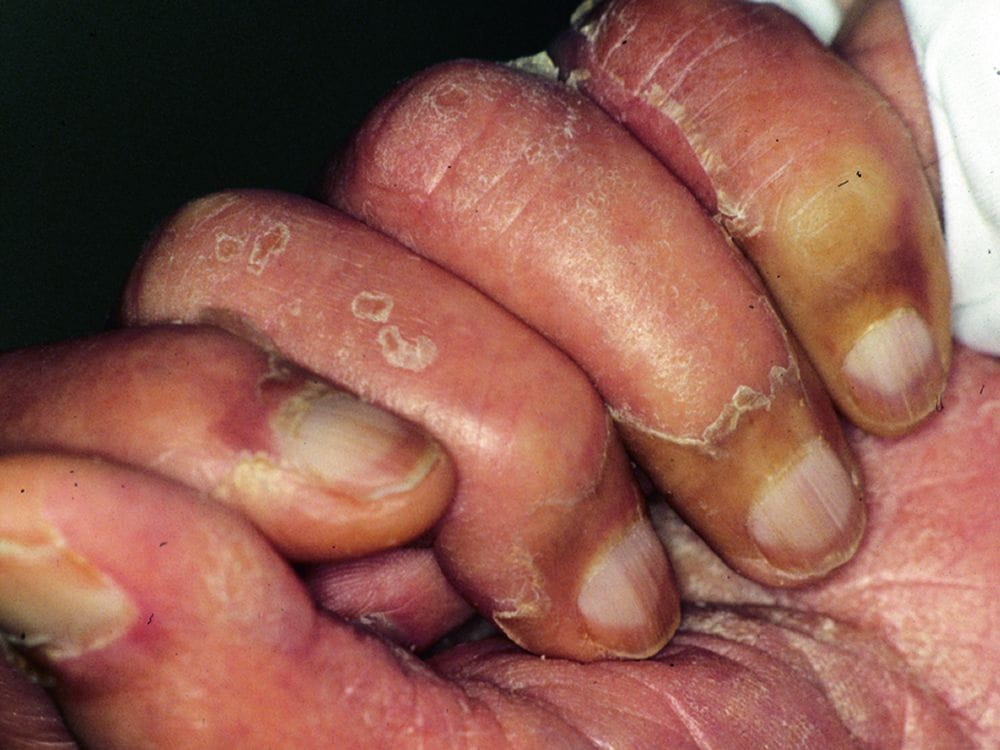 尿毒症的指甲图片图片