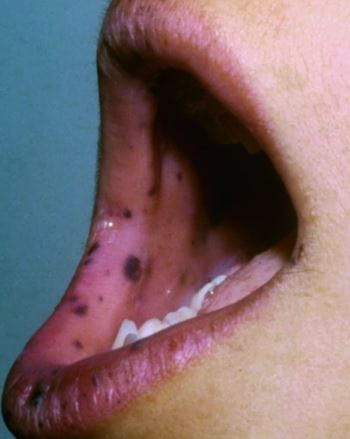 口腔内和嘴唇上蓝黑色斑点（佩-吉综合征）