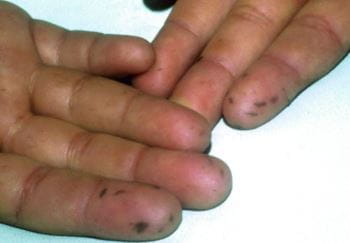手指上蓝黑色斑点（佩-吉综合征）