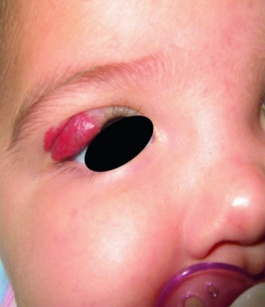 宝宝眼皮血管明显图片图片