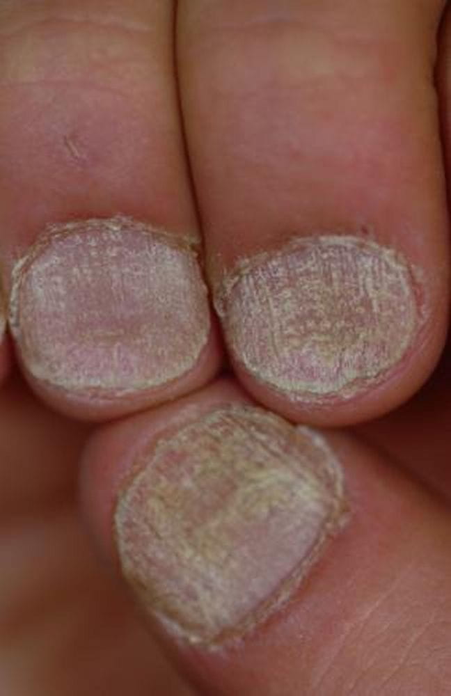 铅中毒指甲的症状图片图片