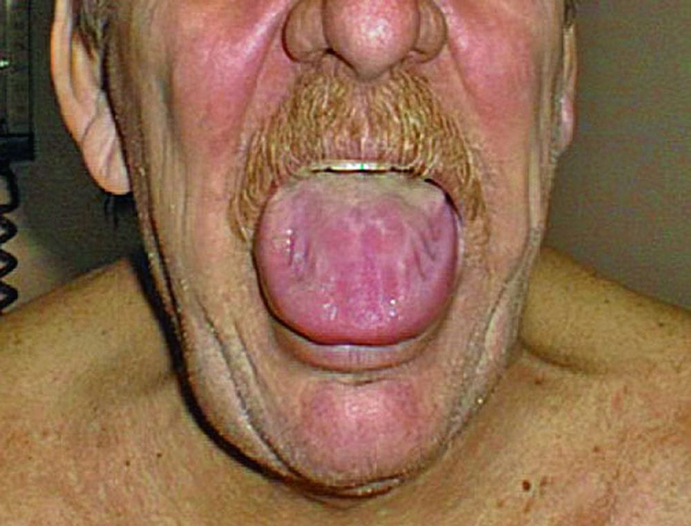 巨舌症图片图片