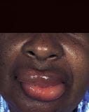 唇和舌肿胀