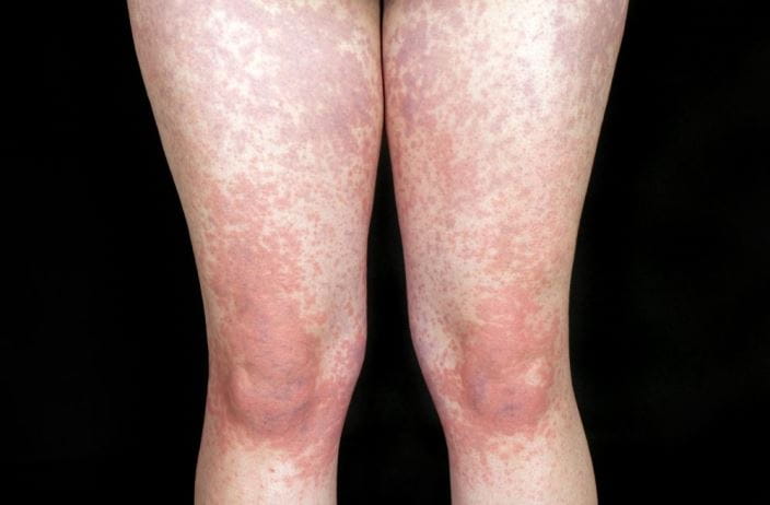 c0259594-infectious-mononucleosis-skin-rash-science-photo-library-high-CV_zh