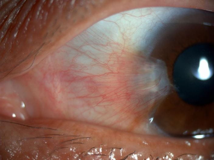 c0271497-pterygium-science-photo-library-high_zh