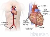 心导管检查术和冠状动脉造影