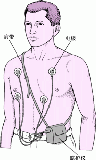 Holter监测：连续心电图记录