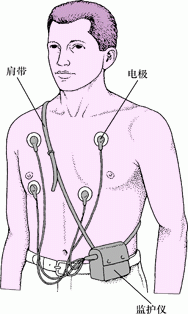 Holter监测：连续心电图记录