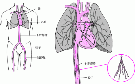 下腔静脉滤器：预防肺栓塞的方法之一