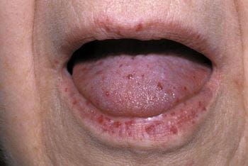 遗传性出血性毛细血管扩张症（嘴唇）