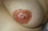 乳腺癌基因突变