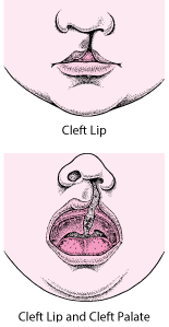 唇裂和腭裂：面部缺陷