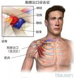 胸廓出口综合征(TOS)