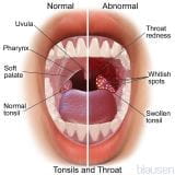 喉咙感染