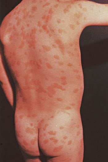 色素性荨麻疹