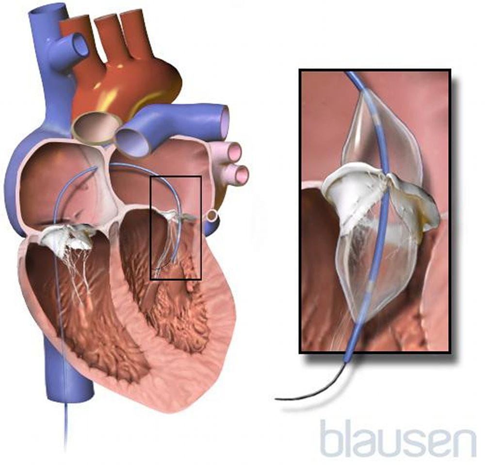 心脏球囊扩张术图解图片