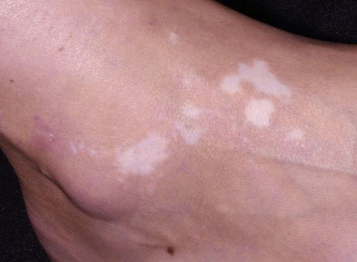 vitiligo_b_orig_high_zh