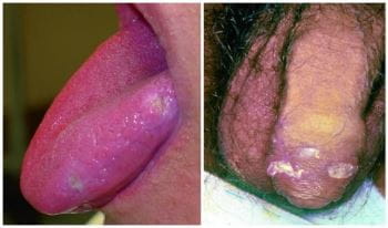 白塞病的口腔和生殖器病变