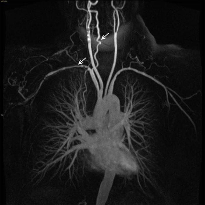 19a-aorta-takayasu-arteritis-arrow-removed-ctisus-sized_zh