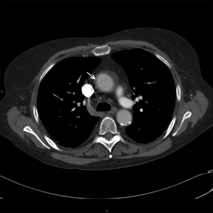 19b-images-of-aorta-in-takayasu-arteritis-ctisus_zh