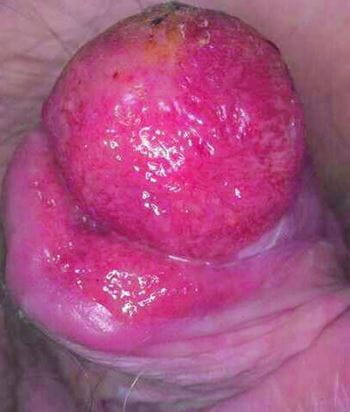 阴茎癌患者Queyrat增殖性红斑