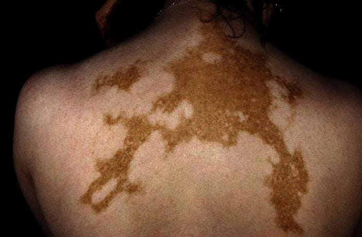 268_vitiligo_slide_74_springer_high_zh