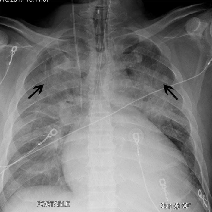 33-chest-xray-of-patient-with-cardiomegaly-and-cephalization-ctisus_zh