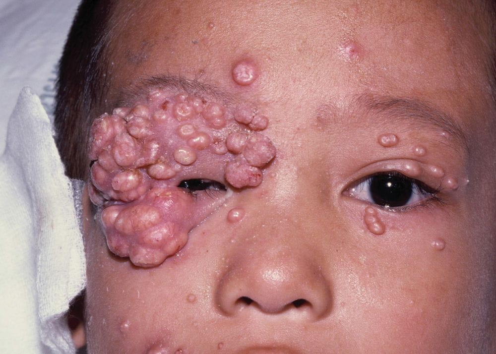 一例hiv感染儿童的传染性软疣