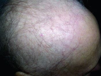 化疗引起生长期脱发