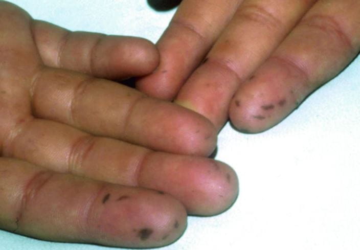 385-peutz-jeghers-syndrome-hand-lesions-slide-12-springer-high_zh